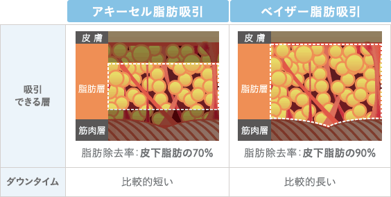 吸引できる層：アキーセル脂肪吸引は脂肪除去率70％（皮下脂肪）、ベイザー脂肪吸引は脂肪除去率90％（皮下脂肪） | ​​ダウンタイム：アキーセル脂肪吸引は比較的短い、ベイザー脂肪吸引は比較的長い