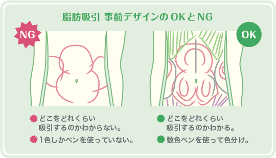 脂肪吸引事前デザインのOKとNG | NG：どこをどれくらい吸引するのかわからない、１色しかペンを使っていない | OK：どこをどれくらい吸引するのかがわかる、数色ペンを使って色分け