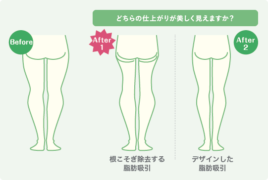どちらの仕上がりが美しく見えますか？ | Brfore | After1：根こそぎ除去する脂肪吸引 | After2：デザインした脂肪吸引