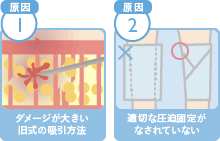 脂肪吸引後に内出血が消えない理由