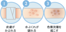 脂肪吸引後に色素沈着が起きる原因