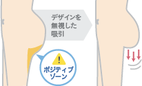 脂肪吸引でお尻が垂れる理由