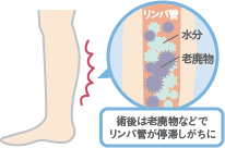 脂肪吸引後にむくみが引かない原因