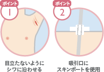 脂肪吸引で傷跡が目立つ原因