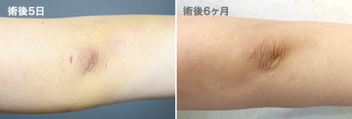術後５日 | 術後６ヶ月