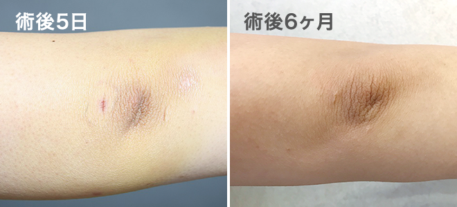 脂肪吸引のよくある質問 医師が回答します